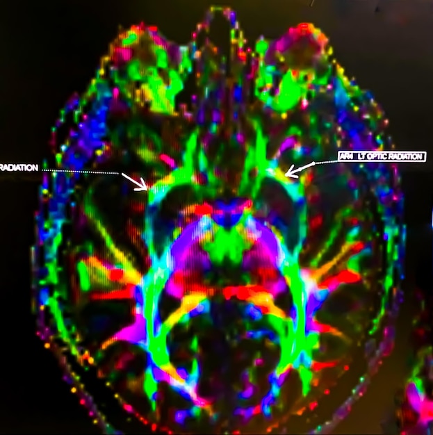 A close-up of brain scans showing reduced activity in the amygdala during meditation. The scans are displayed on a computer screen with annotations explaining the different brain regions.