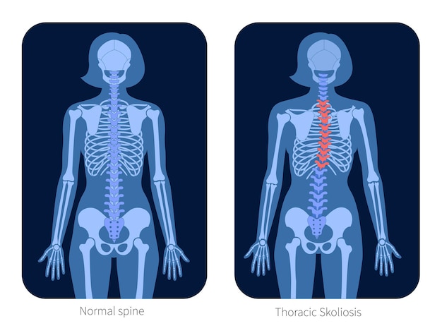 An anatomical illustration showing the differences between a properly aligned spine and a misaligned spine due to poor posture. Key muscles are labeled.